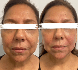 Skin tightening