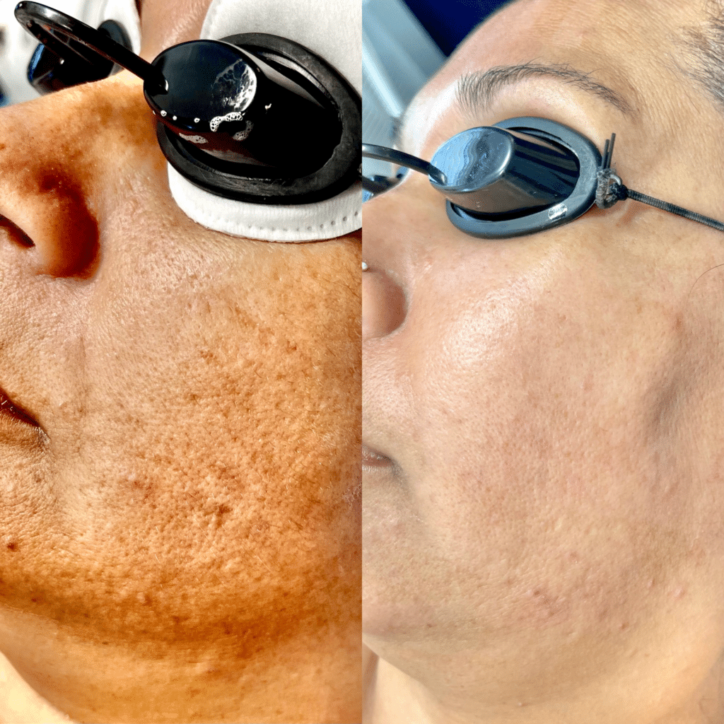 carbon laser facial before after