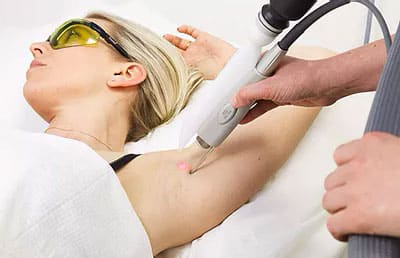 laser hair removal