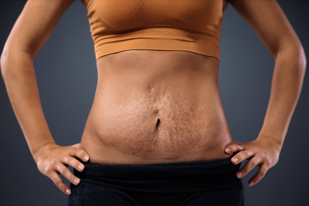 A close-up shot of a woman with stretch marks on her stomach