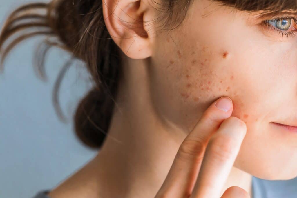 A close-up shot of a woman with acne scars on her cheek that could be minimized with microdermabrasion in McLean, VA